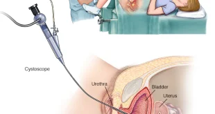 WHAT IS UTI ?